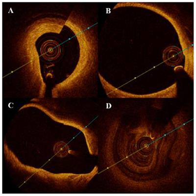 Frequency-Domain Optical Coherence Tomography for Intracranial Atherosclerotic Stenosis: Feasibility, Safety, and Preliminary Experience